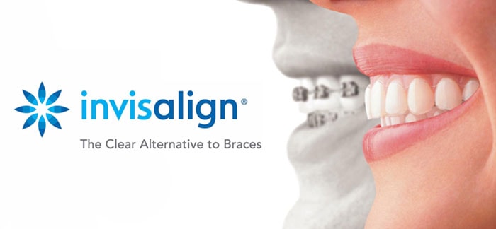 Invisalign