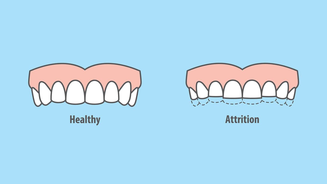 Bruxism dentist